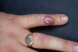 A large blister on the little finger of someone with white skin. There's a red or purple patch with a white blister in the middle.