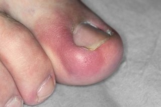A person's big toe that looks red and swollen around their toenail. The side of the toenail has grown into the toe.