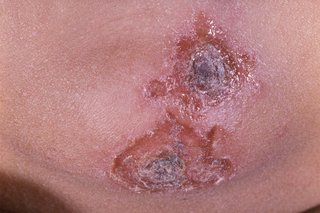 Impetigo on the chin. There are 2 patches that have dark brown scabs in the middle surrounded by lighter areas of weeping skin. Shown on medium brown skin.
