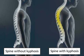 Diagram of 2 spines, one with kyphosis and one without. There is a bigger curve in the top part of the spine with kyphosis.
