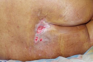A pressure ulcer on the bottom of someone with light brown skin. There are dark purple patches with red and pink areas in the middle.