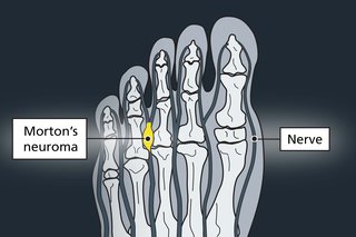 Illustration showing the bones in the top of the foot or toe area. There is a red area between the joints of the 3rd and 4th toes, showing the nerve Morton's neuroma usually affects.